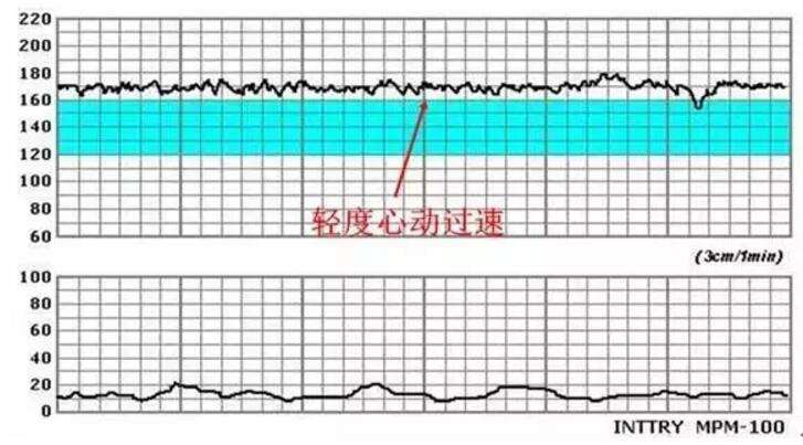 胎心監(jiān)護(hù)圖怎么看正常,胎心監(jiān)護(hù)圖解讀指南，如何判斷正常與進(jìn)行精細(xì)評估,實地評估數(shù)據(jù)方案_Nexus20.35.80