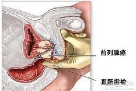 前列腺治療的新方法,前列腺治療的新方法，科學評估解析,實時更新解釋定義_尊貴款95.84.24