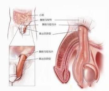 附睪炎癥狀,附睪炎癥狀與精細化計劃設計的探索,迅速執行解答計劃_封版63.85.69