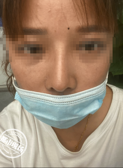 女子花數萬修復鼻孔卻被弄歪鼻梁