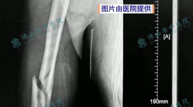 兩小伙與機器人掰手腕當(dāng)場骨折