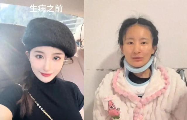 女生確診漸凍癥一年容貌巨變